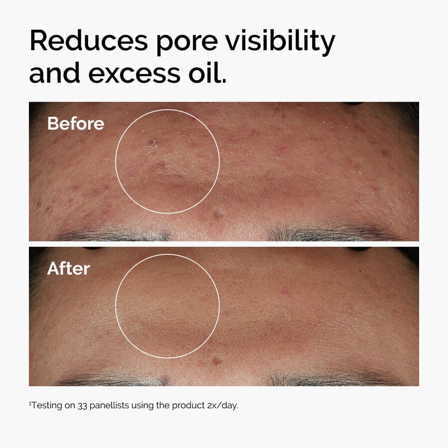 niacinamide-10-zinc-1-z0 ord-niacinamide-zinc-blemish-serum-before-after-pores.jpg