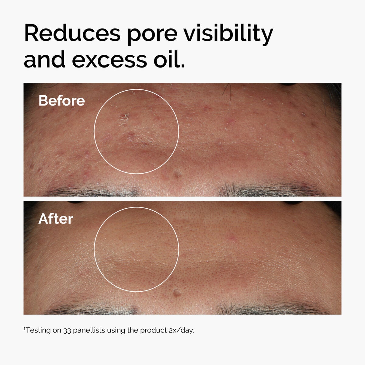 niacinamide-10-zinc-1-z0 ord-niacinamide-zinc-blemish-serum-before-after-pores.jpg